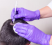 Hair Transplant Treatment in Lokhandwala-Andheri