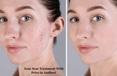 Acne Scar Treatment With Price in Andheri