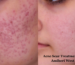 Acne Scar Treatment in Andheri West