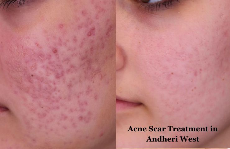 Acne Scar Treatment in Andheri West