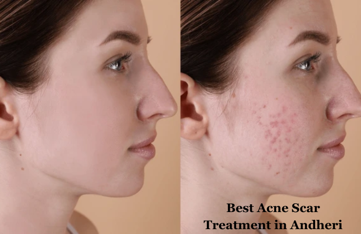 Best Acne Scar Treatment in Andheri