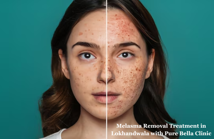 Melasma Removal Treatment in Lokhandwala