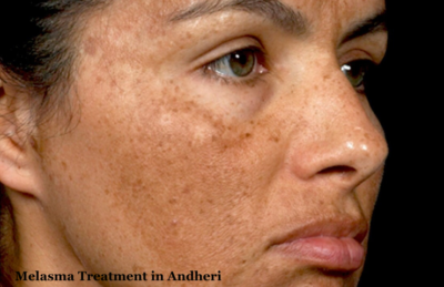 Melasma Treatment in Andheri