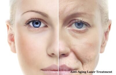 Anti-Aging Laser Treatment In Lokhandwala, Andheri