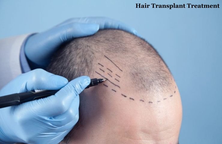Hair Transplant Treatment in Andheri West