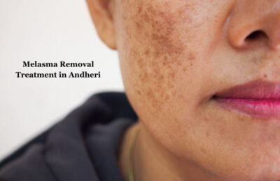Melasma Removal Treatment in Andheri