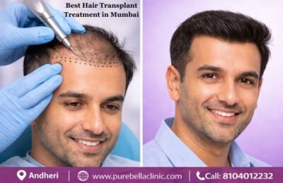 Best Hair Transplant Treatment in Mumbai