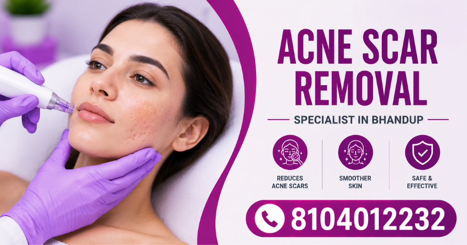 Acne Scar Removal Specialist in Bhandup
