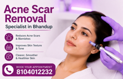Acne Scar Removal Specialist in Bhandup