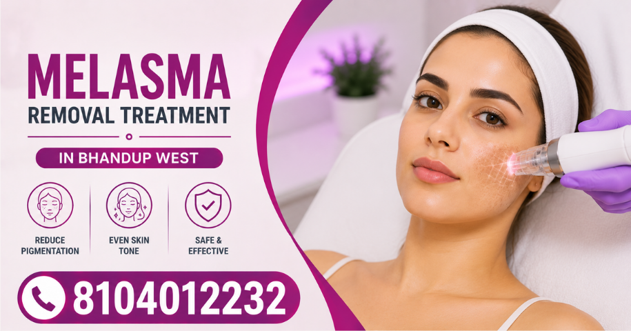 Melasma Removal Treatment in Bhandup West