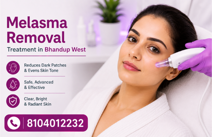 Melasma Removal Treatment in Bhandup West