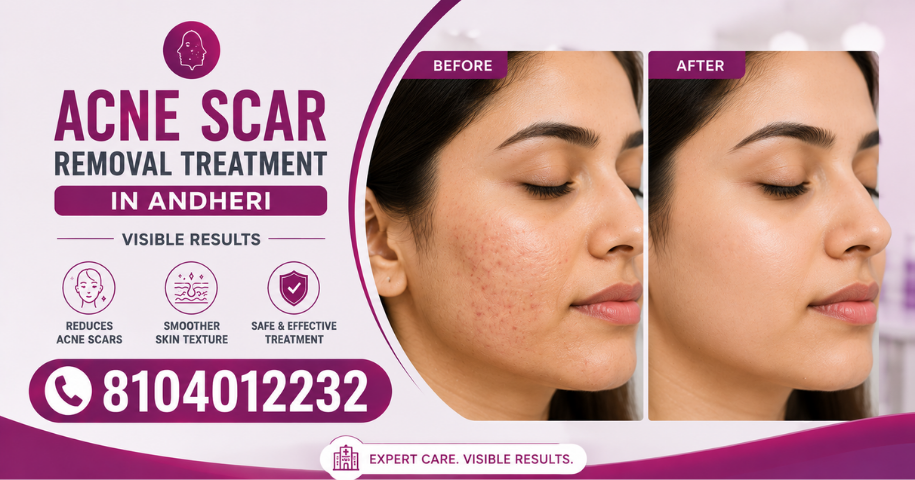 Acne Scar Removal Treatment in Andheri
